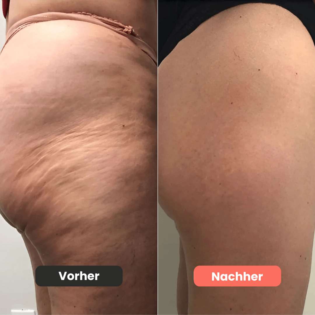 Cellugone 3.0 - Sichtbar glattere & straffere Haut